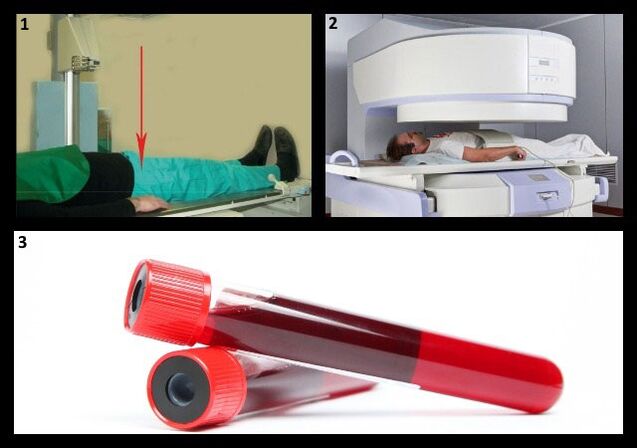 روش های تشخیص کوکسارتروز - اشعه ایکس و MRI مفصل ران ، آزمایش خون