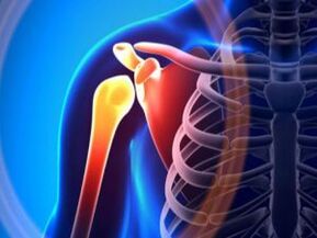 مفصل شانه ملتهب به دلیل آرتروز - یک بیماری مزمن سیستم اسکلتی عضلانی