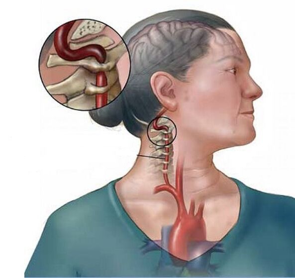 سندرم شریان مهره ای با استئوکندروز گردنی